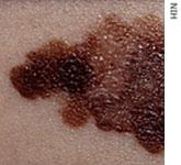 Malignant melanoma