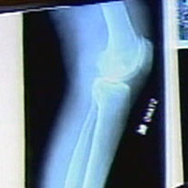 X-ray of knee